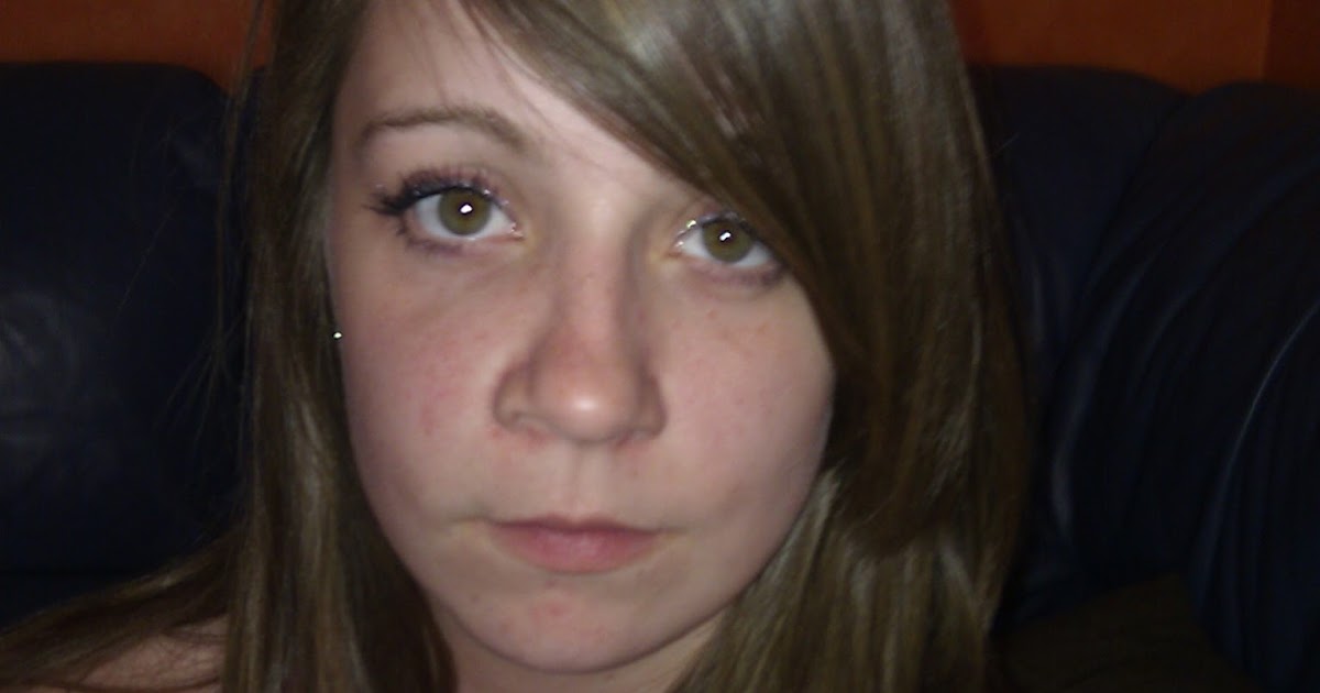 EmBracing Upper and Lower Jaw Surgery Day 406 Fat Face Returns......