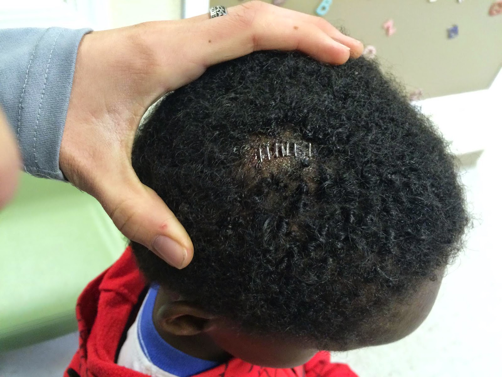 If You Have Staples In Your Head Can You Shower at Ronnie King blog