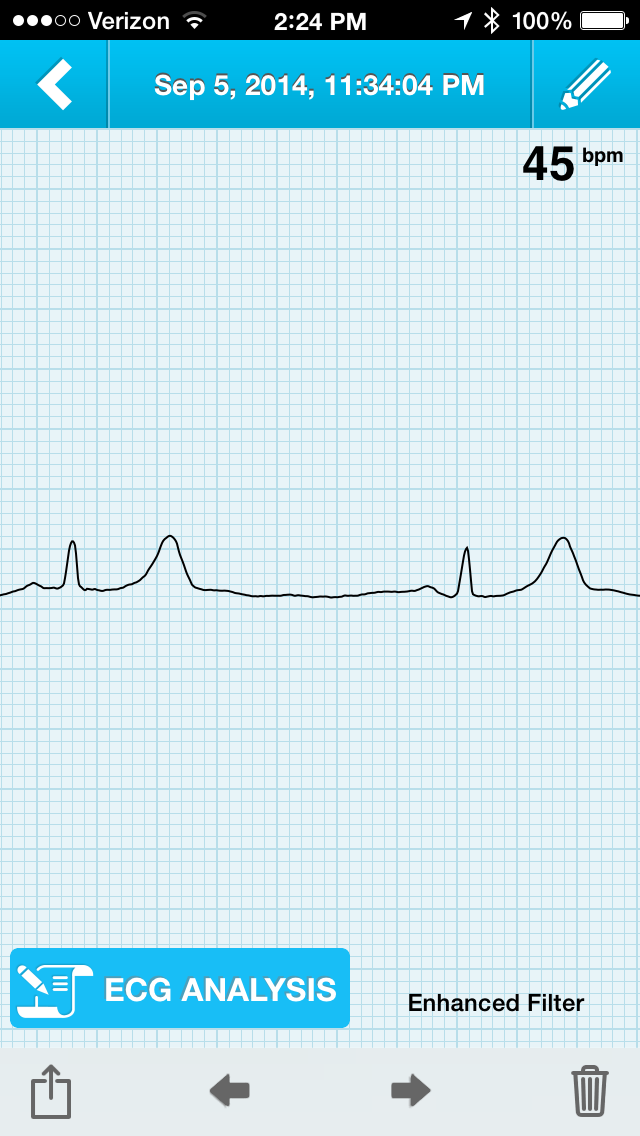 Fitness Tech M.D. by DrJosephKim Athletic heart syndrome (athletic