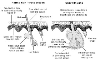 How to treat back acne from steroids