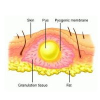 Cara mengobati bisul dengan cepat dan alami | Artikel kesehatan dan