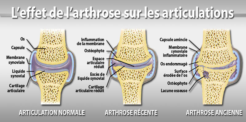 blog 75 infos santé arthrose et rhumatismes causes of