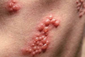 Penyakit Herpes Di Di Kulit