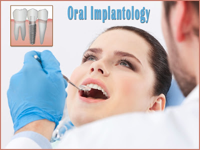 Oral Implantology PPT