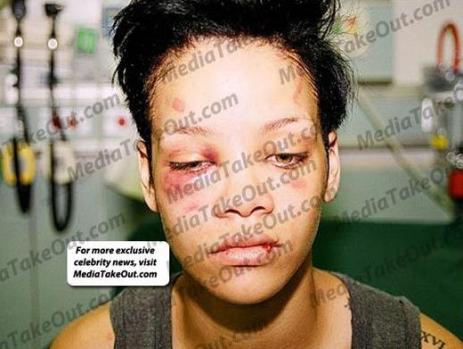 rihanna-beat-up-bruised-face_463x349.jpg