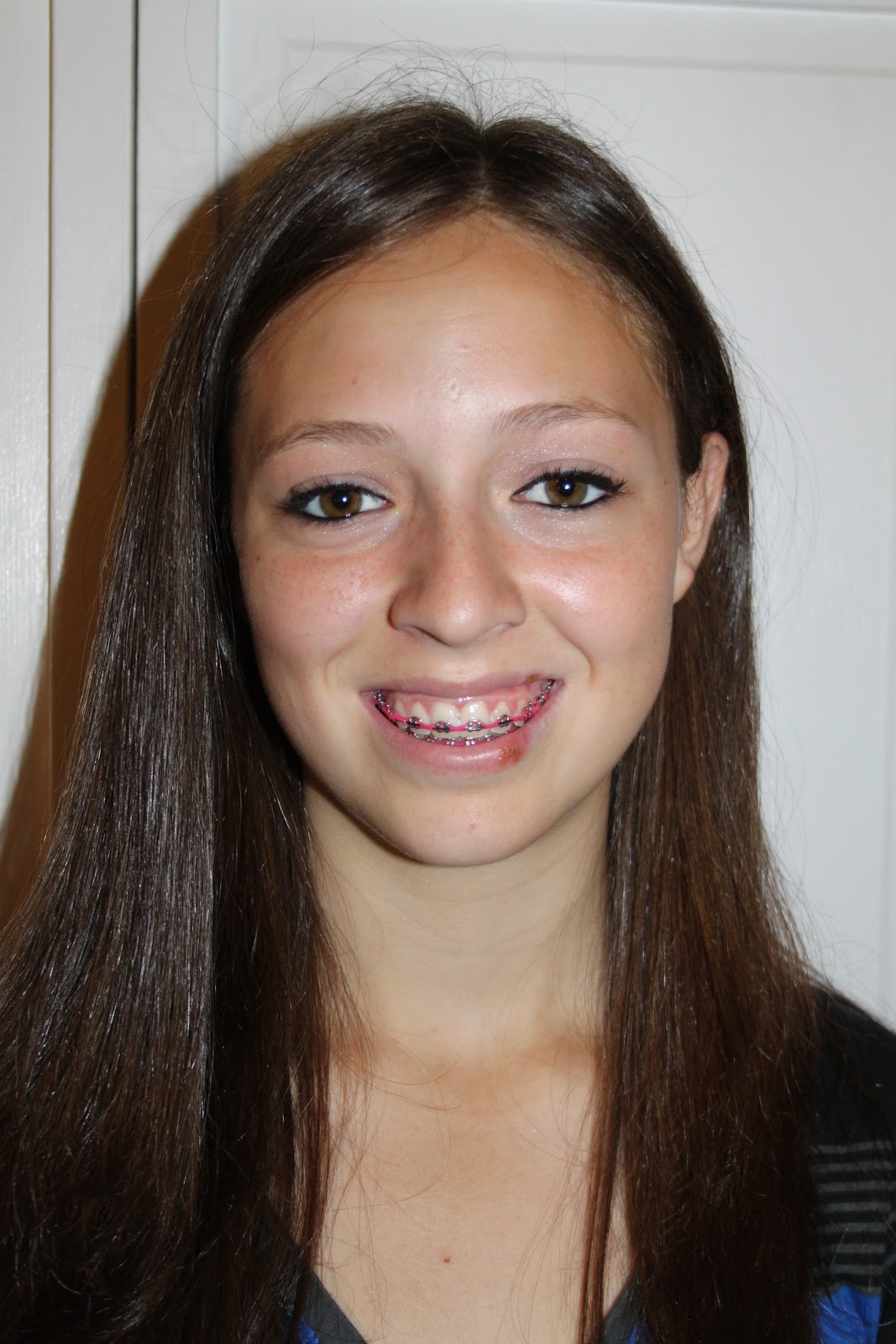 Our Forever Family... Freedom from braces...