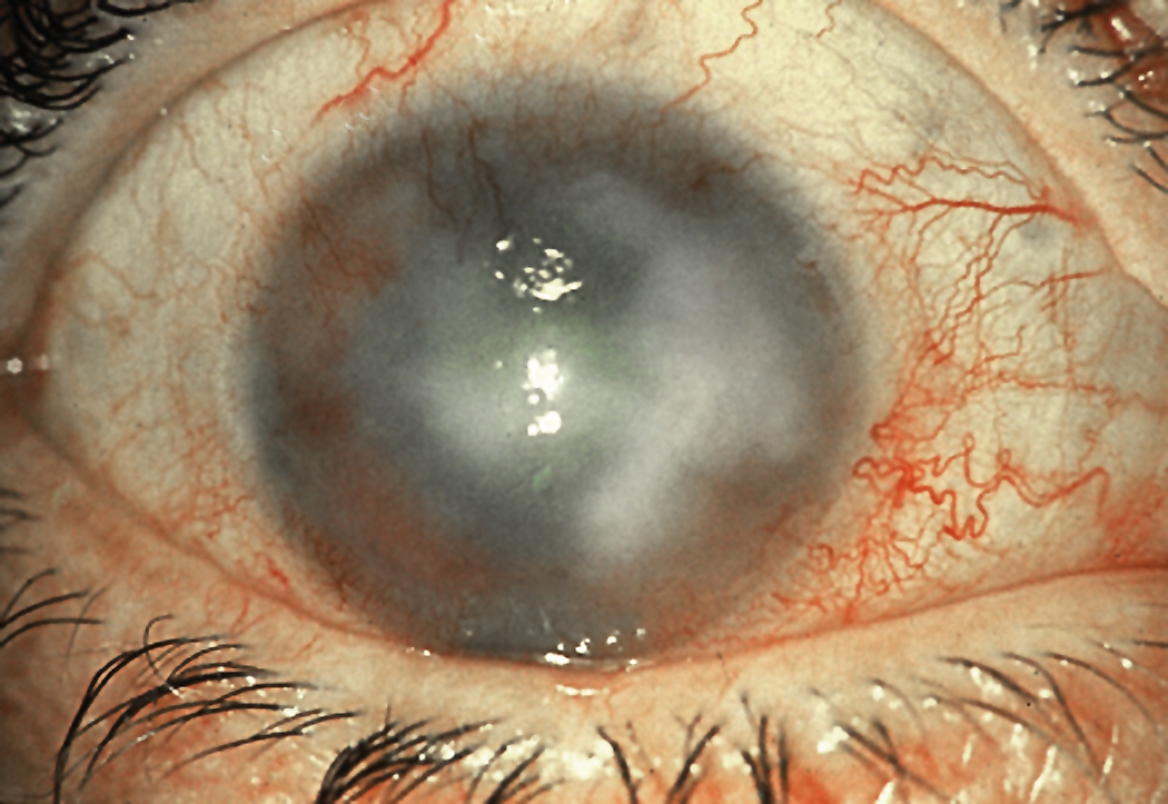 Eyes Herpes