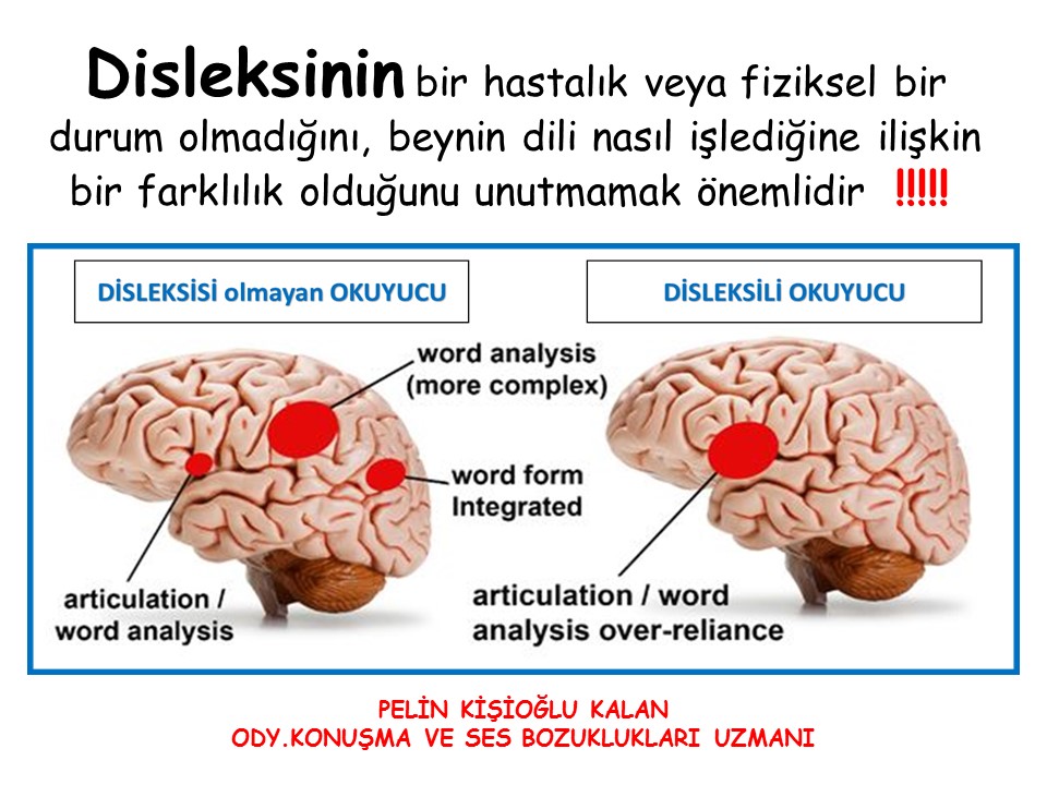 DİSLEKSİ