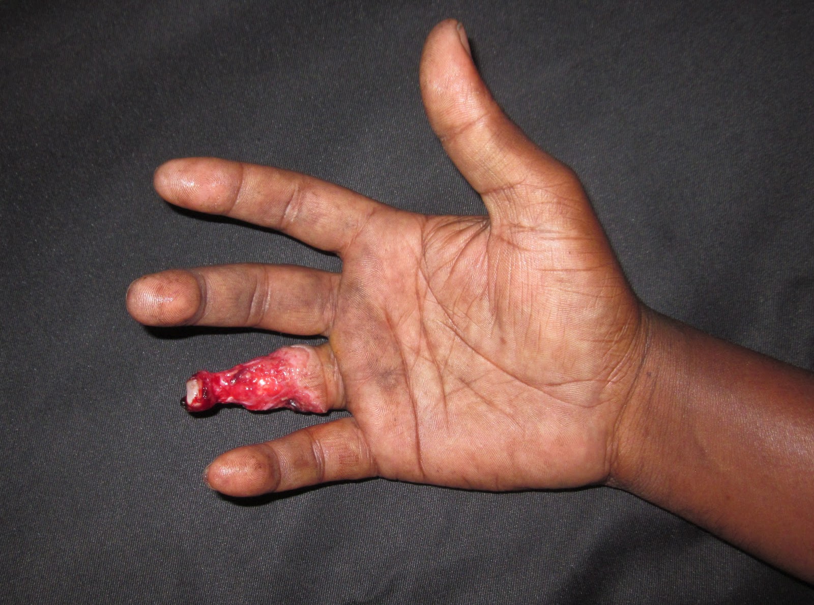 How Common Is Ring Avulsion Injuries