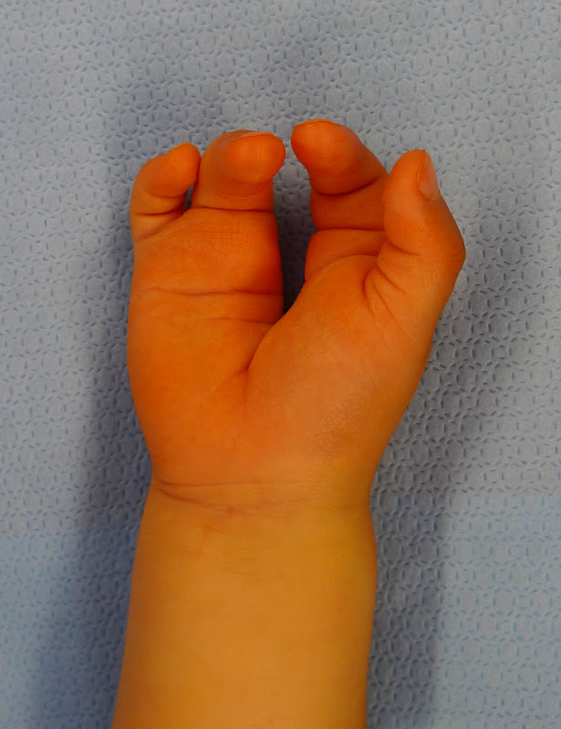 Cleft Hand Surgery Congenital Hand and Arm Differences Washington