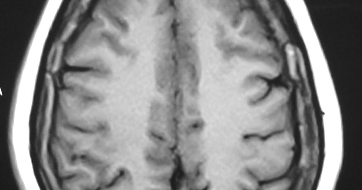 Radiodiagnosis - Imaging is Amazing-Interesting cases: Calvarial
