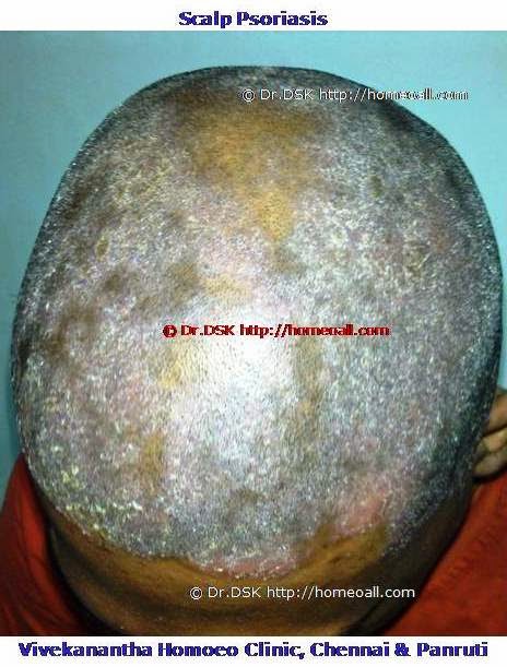  scalp psoriasis specialist dr.sendhil kumar chennai 9786901830