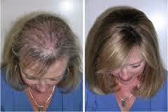 Hair loss solutions 