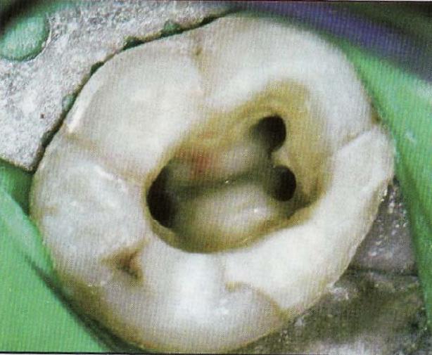 Access Cavity