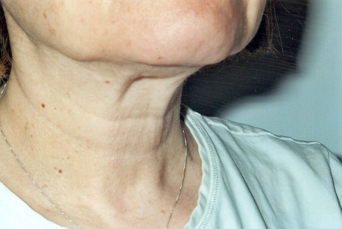 Yoga Facial Exercises For Lines