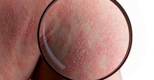 El tratamiento por el solano de la psoriasis