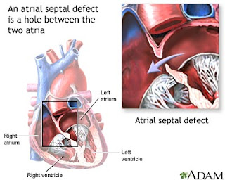 Nursing Intervention for Atrial Septal Defect Nursing Care Plan Atrial Septal Defect Assessment Diagnosis(ASD)
