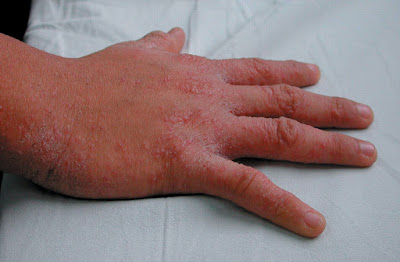 Stromectol 3 mg posologie Stromectol 3 mg posologie