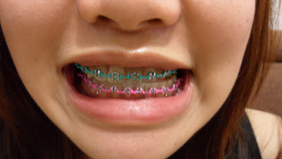 braces pink turquoise powerbands jasminetay chose 8th whole colour row together