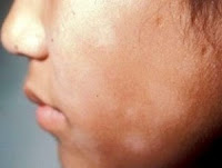 http://sayherbal.blogspot.co.id/2015/09/cara-menyembuhkan-penyakit-vitiligo.html