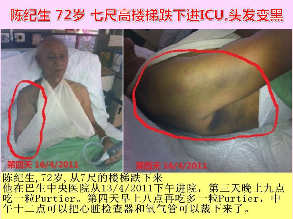 TAN KEE SANG (72 YEARS O) - FALL FROM 7FT HEIGHT LADDER AMITTED INTO ICU, HAIR GROW TO DARKER COLOR