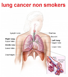lung cancer non smokers pictures and images 