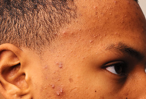 Topical corticosteroids acne scars
