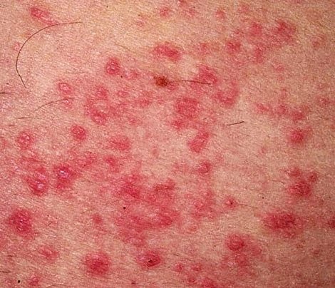 Como ser curado de atopicheskogo de la dermatitis