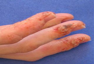 Dyshidrose La dyshidrose est une forme d' eczéma, dit eczéma bulleux, surtout présent sur les faces palmaires et/ou plantaires. Le nom provient du mot dyshidrotique, signifiant mauvaise sueur laquelle fut autrefois perçue comme la cause. Quelquefois elle est appelée Pompholyx (bulles en grec), terme généralement réservé pour les cas de vésicules pruritiques profondes.
