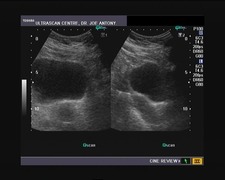 cochinblogs: Kidney stones- renal calculi- urinary stones