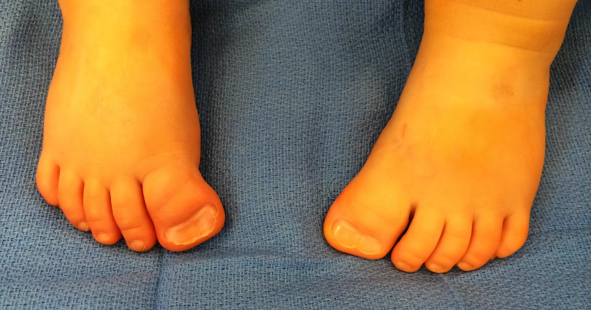 Polydactyly essay 08 image