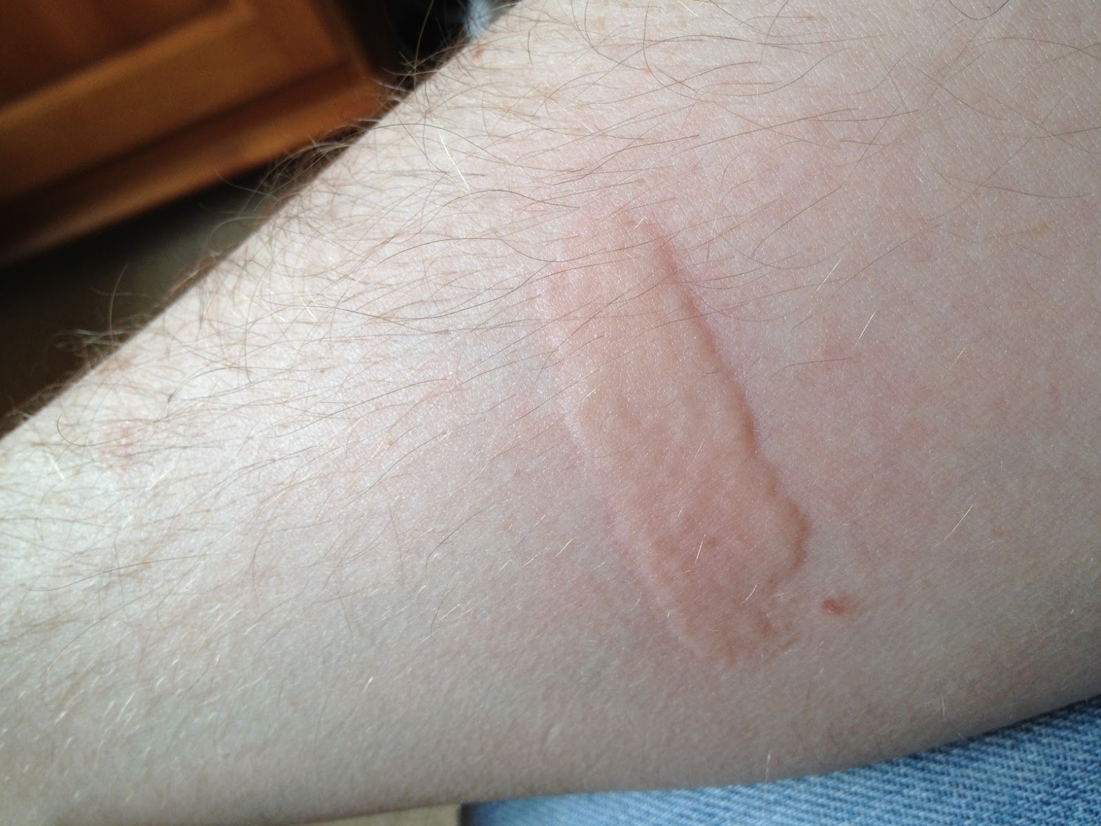 Cold Water Allergic Reaction at Samuel Watterson blog