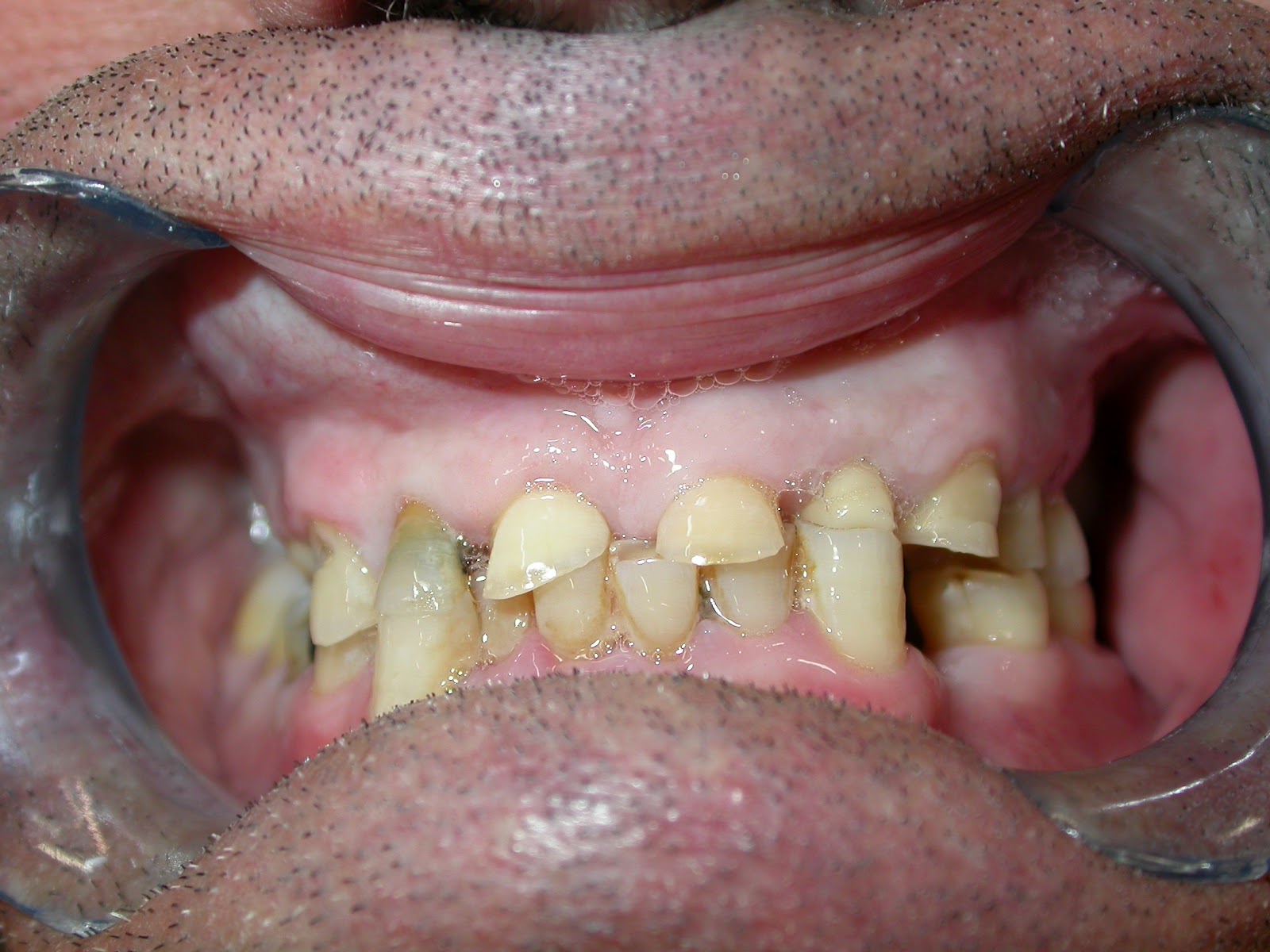 Férula de descarga en Clínica Dental Bejarano - Clínica Dental Bejarano