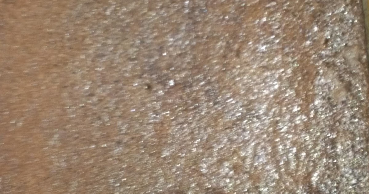 Allergy Lane "Food, Fun, and Family Life with Extreme Allergies"