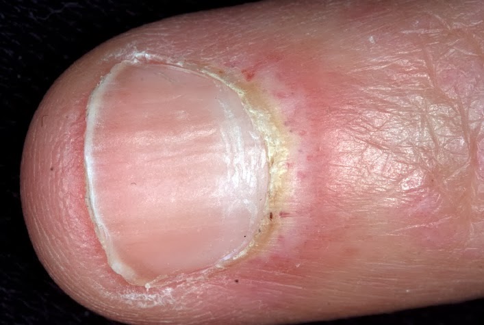 Picture of Dermatomyositis