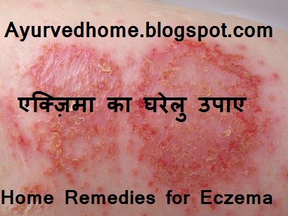 Eczema Home Remedies , एक्ज़िमा उपचार के लिए घरेलु उपाए , Daad Khaj Khujli ,  Daad Khaj Khujli, Eczema Home Remedies, Dry eczema, wet eczema, Aam ki chaal for eczema, babool ki chaap for eczema, Daad khaj khujli, Ayurvedic way to cure eczema,  natural way to cure eczema,