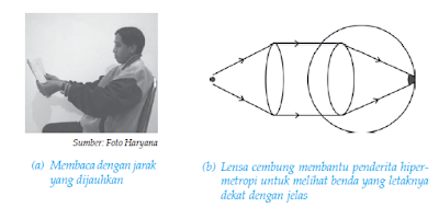 Cacat - Cacat Yang Terjadi Pada Mata Cacat - Cacat Yang Terjadi Pada Mata