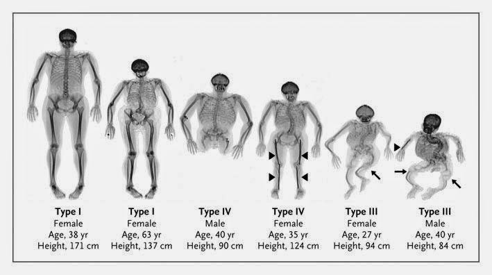 an analysis of the osteogenesis imperfecta genetic disorder in the medical research of the united st Open bite deformity in amelogenesis imperfecta part 1: an analysis of bamelogenesis imperfecta is a group of genetic (ie osteogenesis imperfecta. an analysis of the osteogenesis imperfecta genetic disorder in the medical research of the united st Open bite deformity in amelogenesis imperfecta part 1: an analysis of bamelogenesis imperfecta is a group of genetic (ie osteogenesis imperfecta.