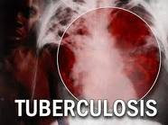 tuberculosis paru