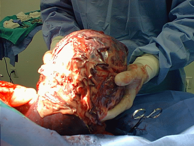 Image Result For Gastrointestinal Stromal Tumors Treatment Image Result For Gastrointestinal Stromal Tumors Treatment