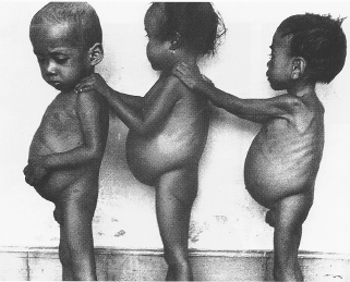 Children With Marasmus