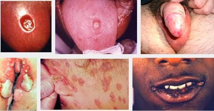 obat sipilis untuk ibu hamil muda, gejalah sipilis, nama obat sipilis yang dijual di apotek
