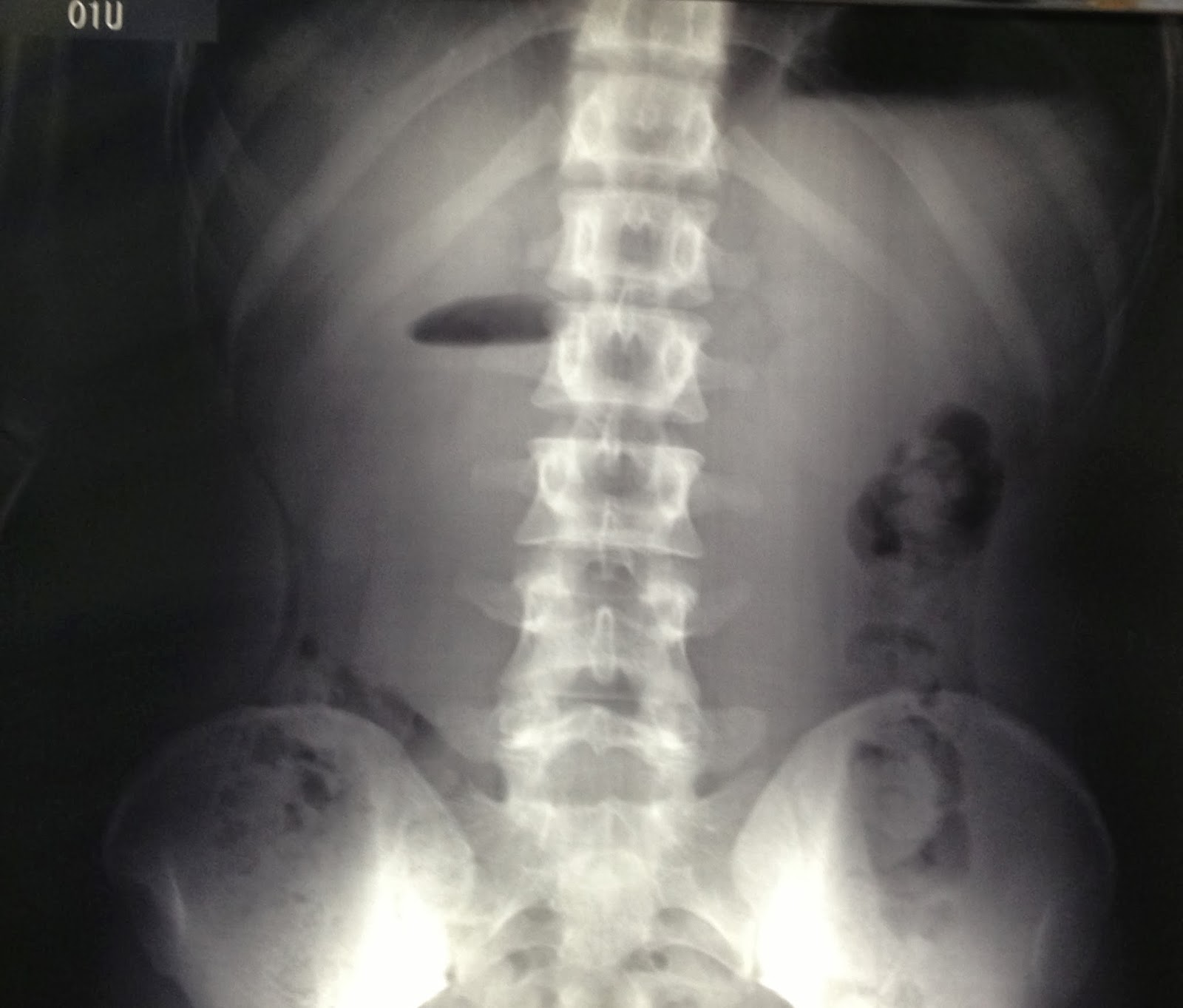 VIETNAMESE MEDIC ULTRASOUND CASE 233 ABDOMINAL MASS AFTER TRAUMA, Dr