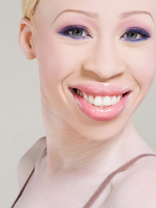 albinism model