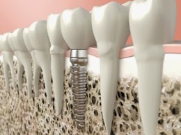 Choses que vous devez savoir avant d'obtenir des implants dentaires