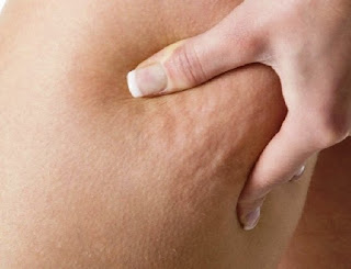 Причины и стадии целлюлита – от чего возникает целлюлит