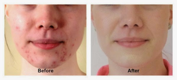 Bekas Jerawat Merah Obat Jerawat Cap Wayang