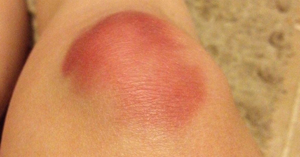 Knee Contusion (Bruised Knee) Causes, Symptoms, Diagnosis, Treatment