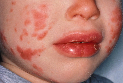 Kawasaki Disease Pictures and Treatments - Please Doctor