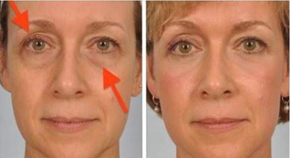 Solve Your Sagging Eyelids Problem Naturally In 2 Minutes Solve Your Sagging Eyelids Problem Naturally In 2 Minutes